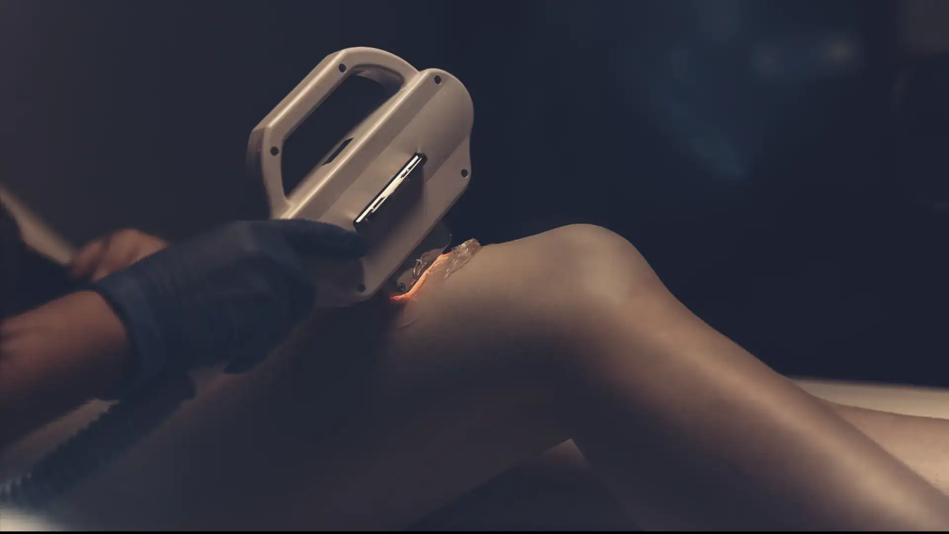 Laser Hair Removal